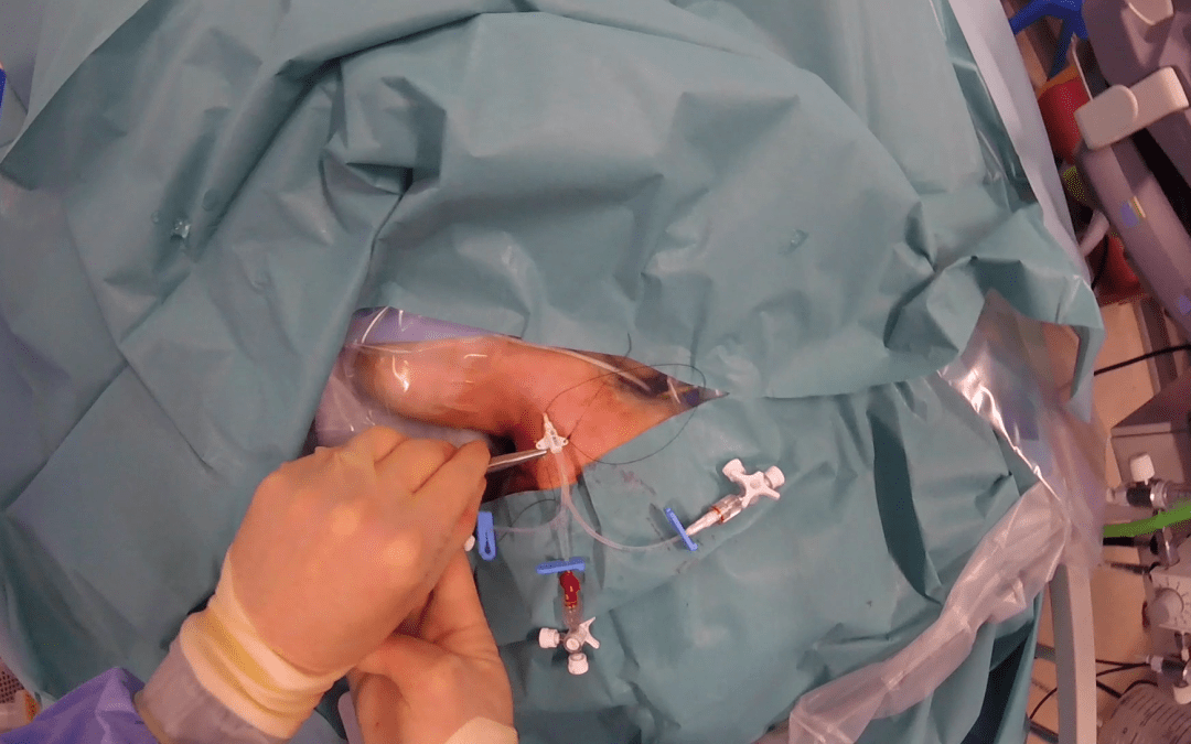Central Venous Line Insertion