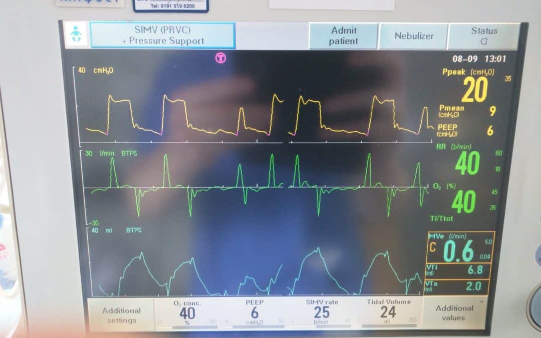 Setting up the Ventilator