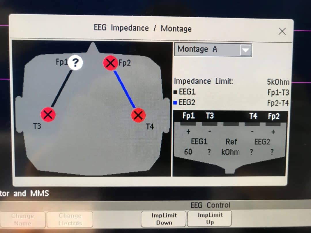 Setting up the Compressed Spectral Array (CSA) | Paediatric Emergencies