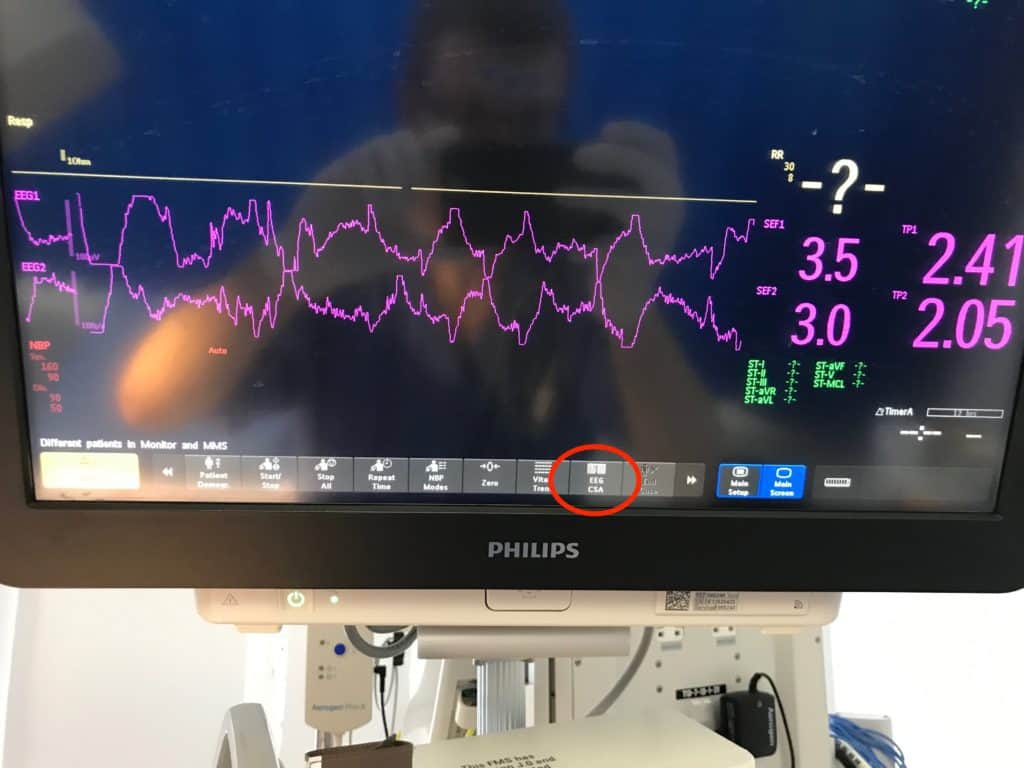 Setting up the Compressed Spectral Array (CSA) | Paediatric Emergencies