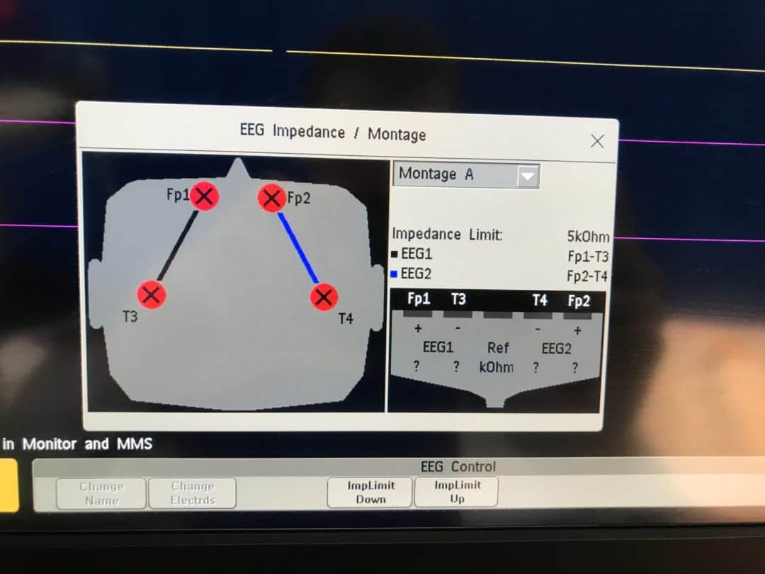 Setting up the Compressed Spectral Array (CSA) | Paediatric Emergencies