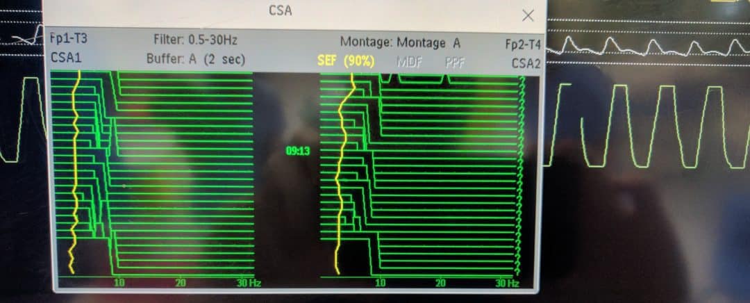 Uses of Compressed Spectral Array in Intensive Care | Paediatric ...