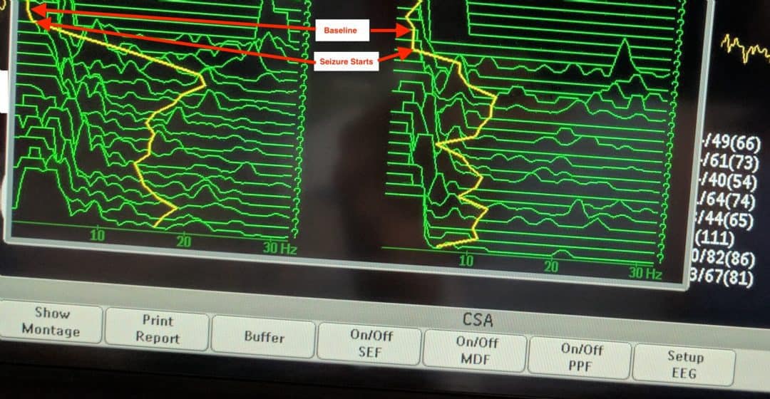 Uses of Compressed Spectral Array in Intensive Care | Paediatric ...